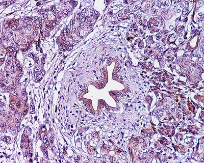 pancreatic ductal adenocarcinoma closeup